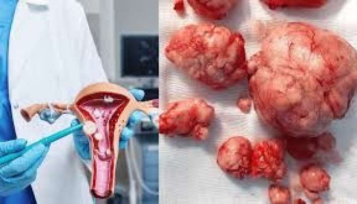 Bədəndə mioma və kistalar niyə yaranır?   - Psixoloji səbəbləri