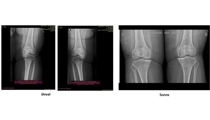 Protez təklif edildi, amma əməliyyatsız sağaldı –  Real pasiyent hekayəsi-VİDEO