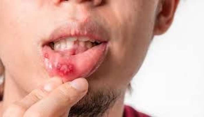 Ağrılı, qanayan ağız yaraları    xərçəng siqnalı verir 