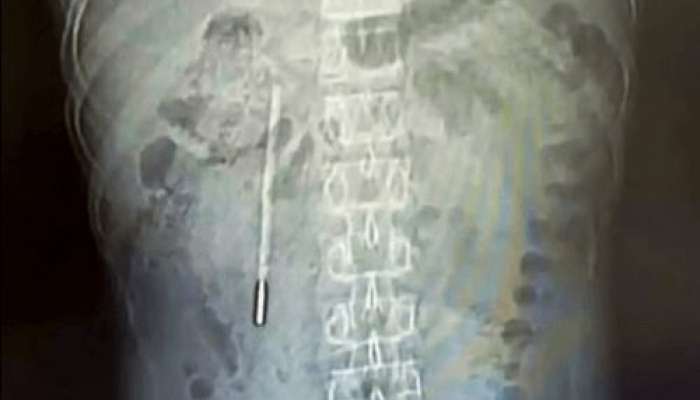 Uşaq vaxtı udduğu termometr  – 20 il sonra çıxarıldı