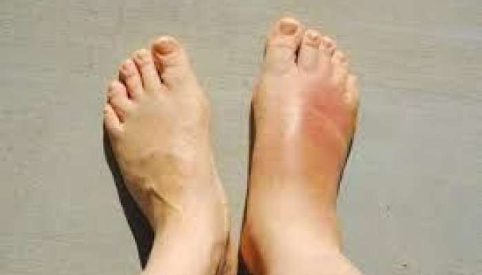 Topuq nahiyəsində şişkinlik və ağrı   - Səbəblər