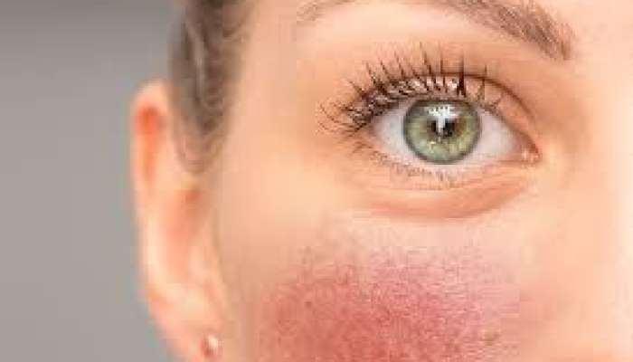 Qırmızı sifət  – Ürəyin xəstə olduğunu göstərir