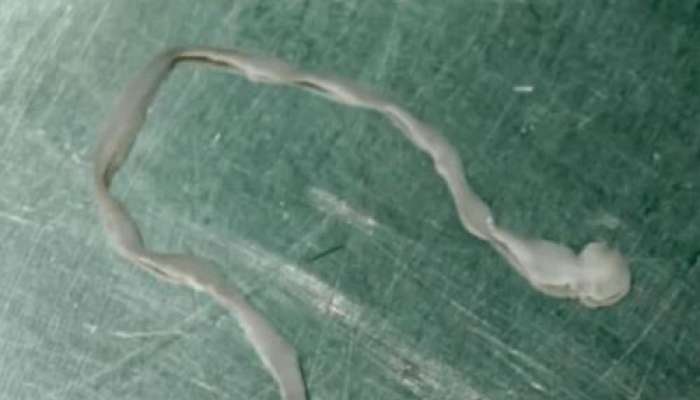 Qadının beynindən 8 santimetrlik    qurd çıxarıldı