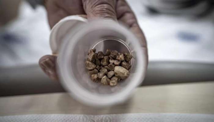 Qadının sidik kanalından 51 daş çıxarıldı -  Həkimlər şokda