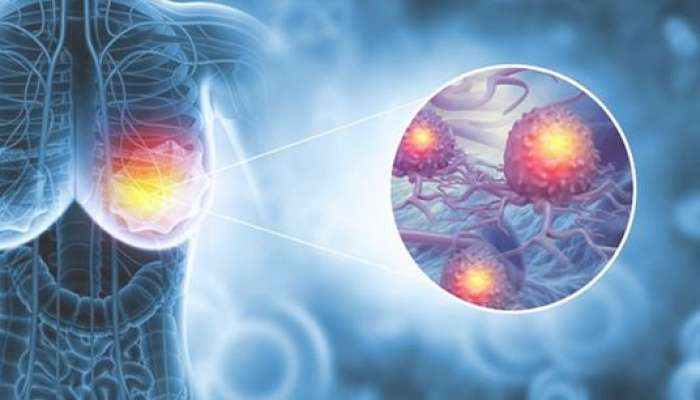 Mamoqrafiya “təmiz” olsa da, xərçəng necə aşkarlandı? -  Real pasiyent hekayəsi-VİDEO