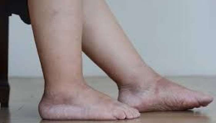 Ayaqların şişməsi yağlı qaraciyərdən    ola bilər