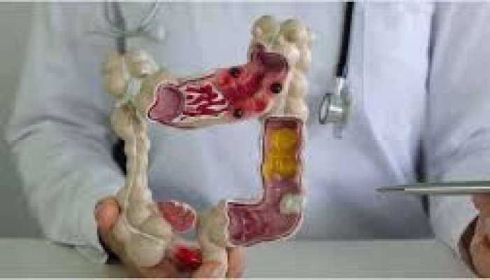 Bədəndə xoşxassəli düyünlər niyə yaranır?  