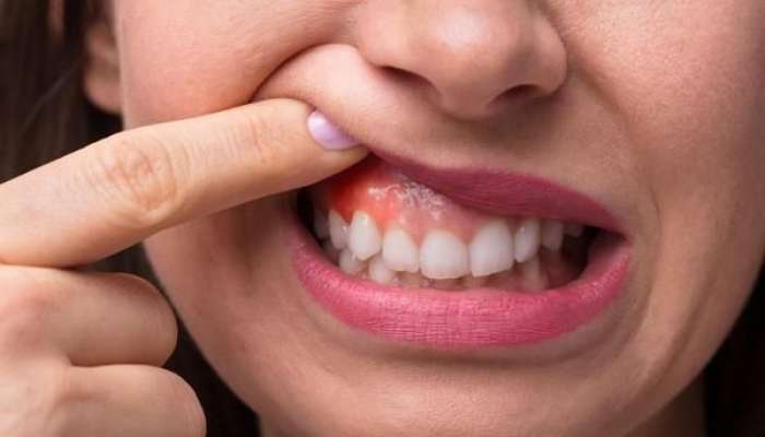 Diş ətiniz qanayırsa, bu vitamin  çatışmır 