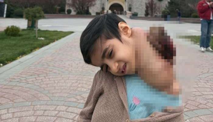 Dünyada ilk -  Uşağın boynundan 3 kiloqramlıq şiş çıxarıldı