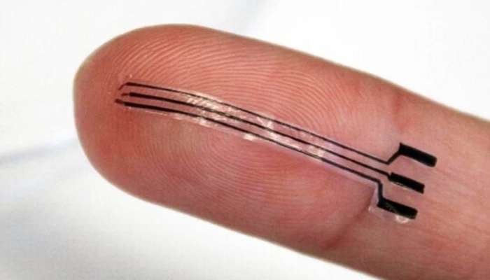 Yüksək təzyiq üçün dərman dövrü başa çatır:  Damara implant yerləşdiriləcək