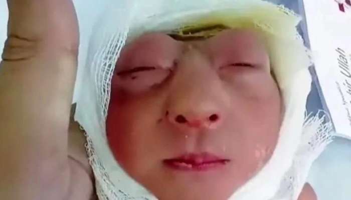 Kəlləsi olmayan körpə doğuldu -  FOTO