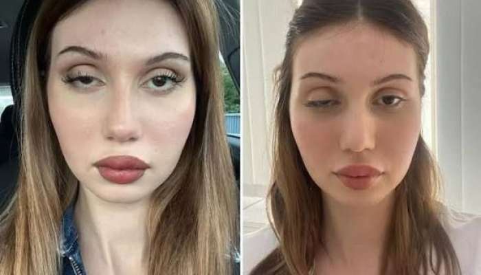 Botoksdan sonra həyatı kabusa çevrildi -  Toyuna 3 ay qalmışdı