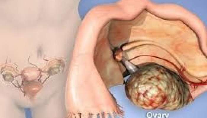 40 yaşından yuxarı qadında bel ağrısı  xərçəngdən də ola bilər