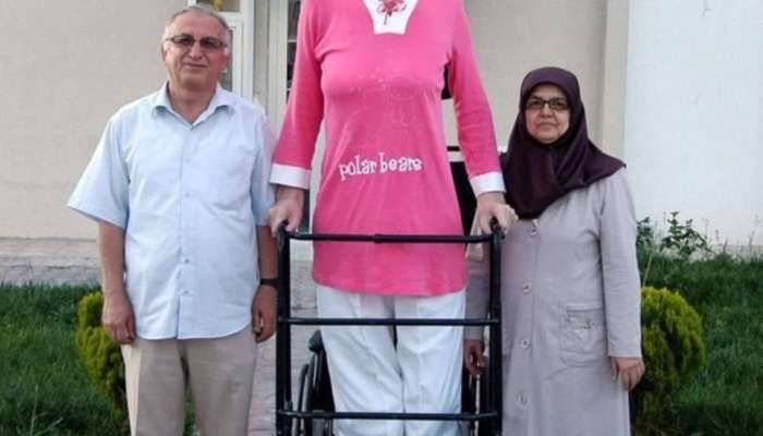 Dünyanın ən uzun boylu qadınının diaqnozu   məlum oldu