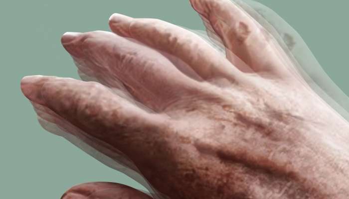 7 il Parkinson xəstəliyi ilə yaşayan pasiyentin mübarizə hekayəsi -  VİDEO