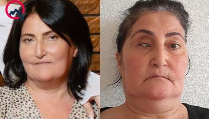 Bu klinika təzminat ödəyəcək -  Burun düzəldəndə gözü zədələyib