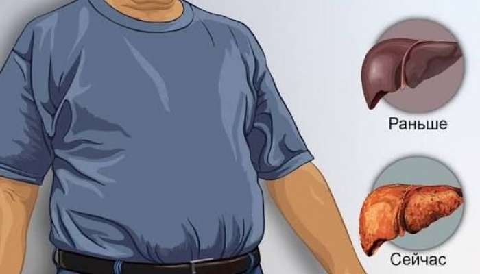 Yağlı qaraciyəri xilas etmək olarmı?  