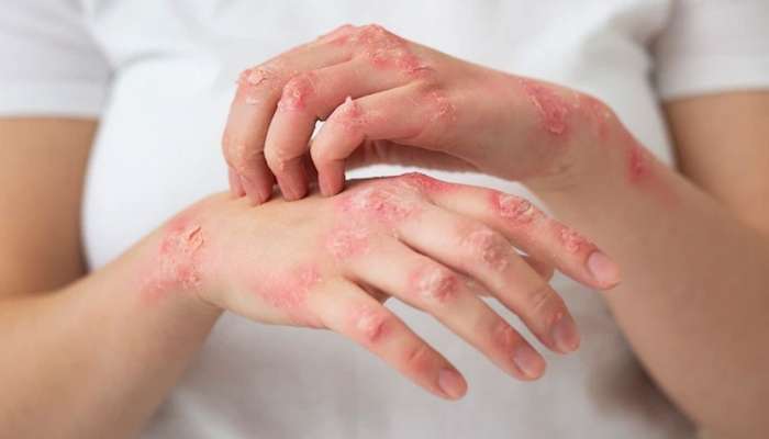 Dəri problemlərinin arxasında nə dayanır? -  Yüksəkdozalı Vitamin C ilə antioksidant müdafiəyə dəstək