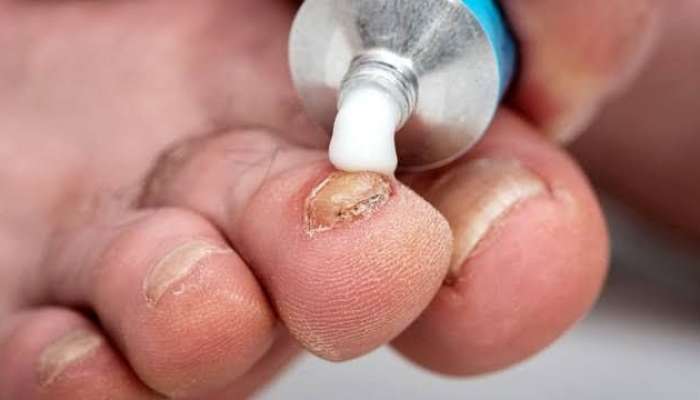 Ayaq dırnağındakı inadkar göbələyi   məhv etmə üsulları
