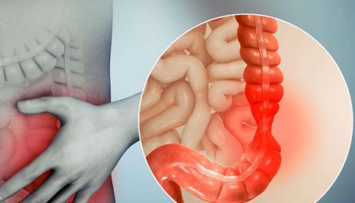 Hemoroid bildi,  xərçəng çıxdı