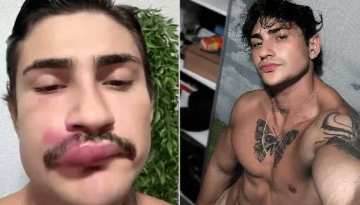 Dodağındakı sızanağı sıxdı, xəstəxanalıq oldu 