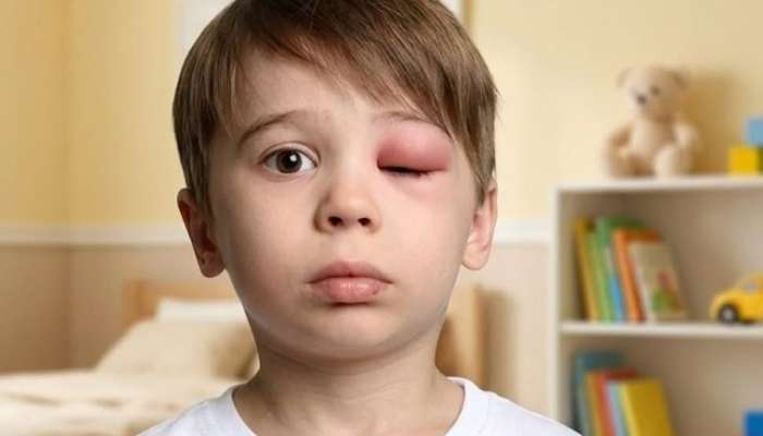 Arı sancması zamanı evdə düzgün müdaxilə -  Pediatrdan