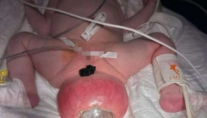 Bakıda büzdüm nahiyəsində nəhəng şiş olan körpə  əməliyyat edildi - FOTO