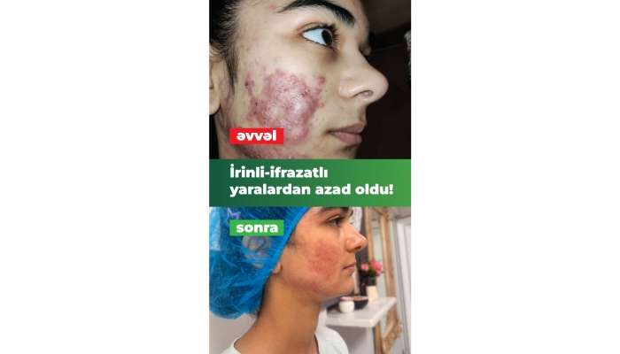 İltihablı sızanaqlar yeniyetmənin həyatını alt-üst etmişdi.  İnteqrativ müalicə ilə həll yolu tapıldı - VİDEO