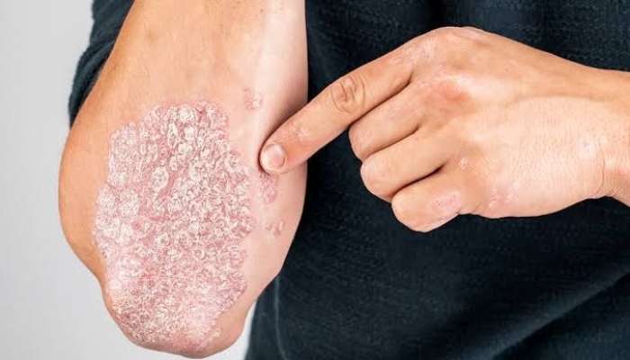 Psoriaz niyə təkrarlanır? -  Mütəxəssis səbəbləri açıqladı - VİDEO