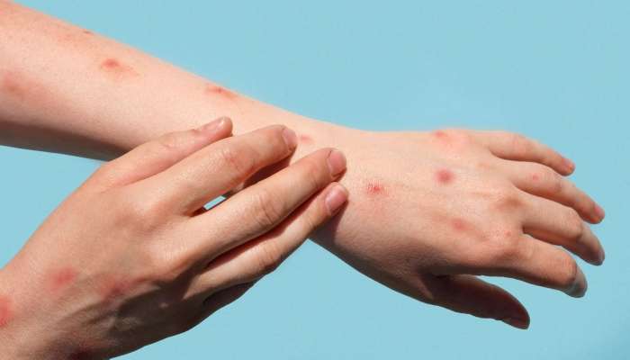 Azərbaycanda meymunçiçəyinə yoluxma var? –  Rəsmi