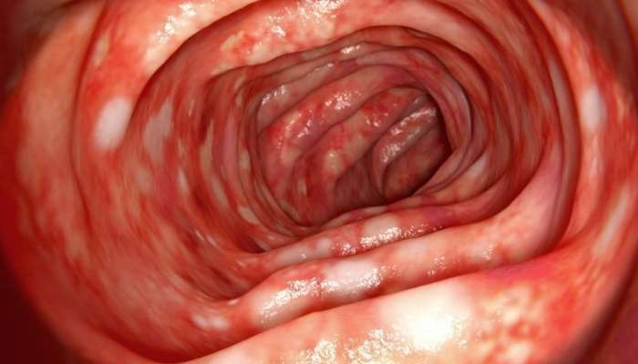  Xoralı Kolitə yeni yanaşma:  Gündə 16–20 dəfə ishal yaşayan xəstənin vəziyyətində dəyişiklik
