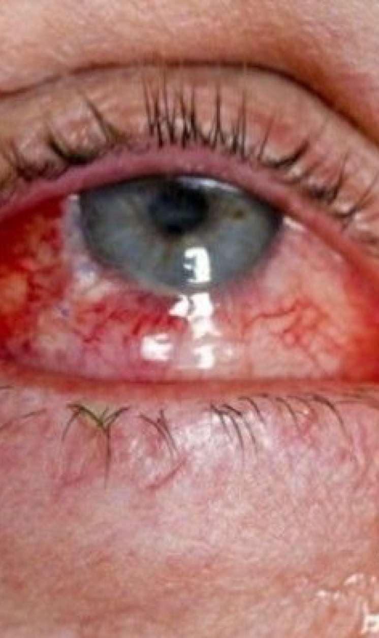 "Qırmızı göz" epidemiyası sürətlə yayılır 