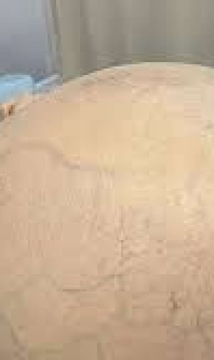 Qadının yumurtalığından 30 kiloqramlıq    şiş çıxardılar