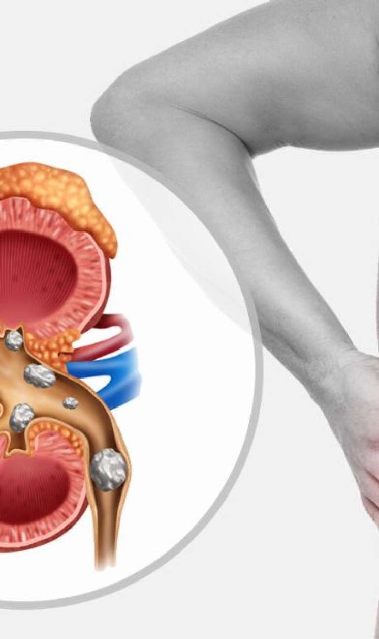 Hər gün bir ovuc yeyin:  Böyrək daşlarını atmağa kömək edir