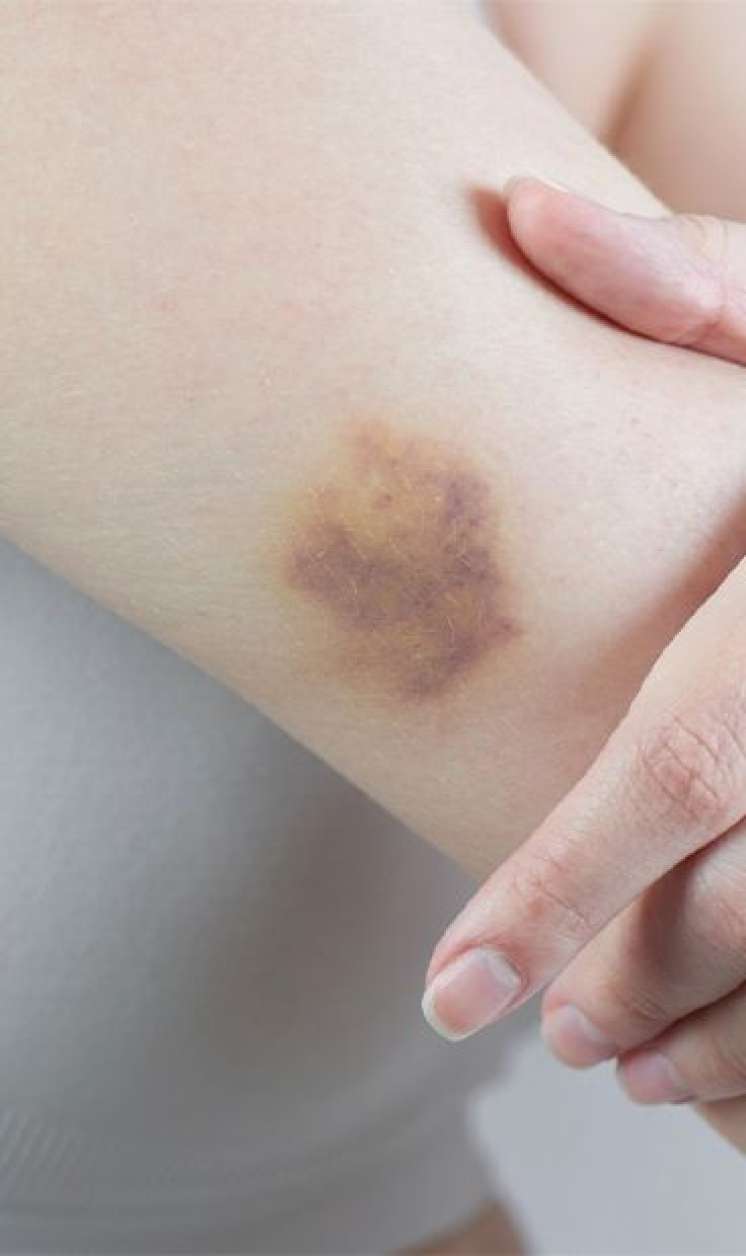 Əl-ayaqda səbəbsiz göyərmələr  – Nə çatışmır?