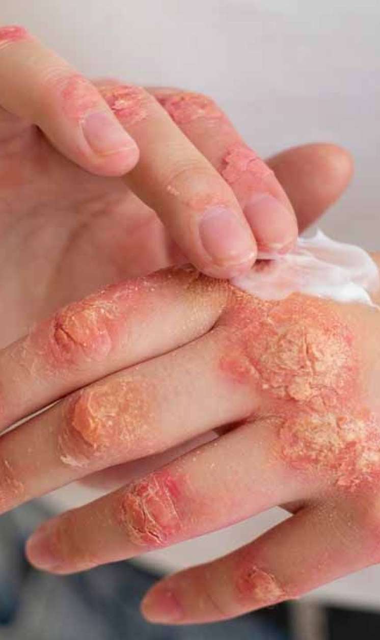 Ekzemaya qarşı krem resepti -  Dərini nəmləndirir