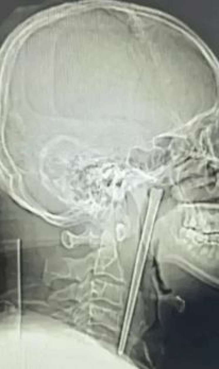 Yemək çubuğunu udan kişi 8 il həkimə getməyib 