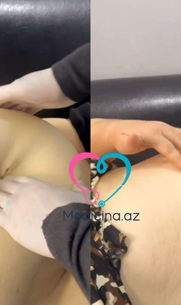 Abdominoplastika əməliyyatından sonra qarnı dəhşətli hala düşdü -  VİDEO