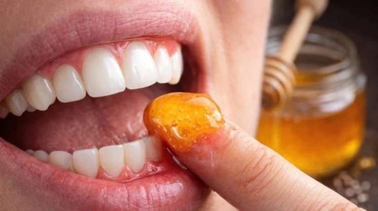 Təbii müalicə -   Diş ətlərinə bal çəkmək sizi diş həkimindən xilas edir