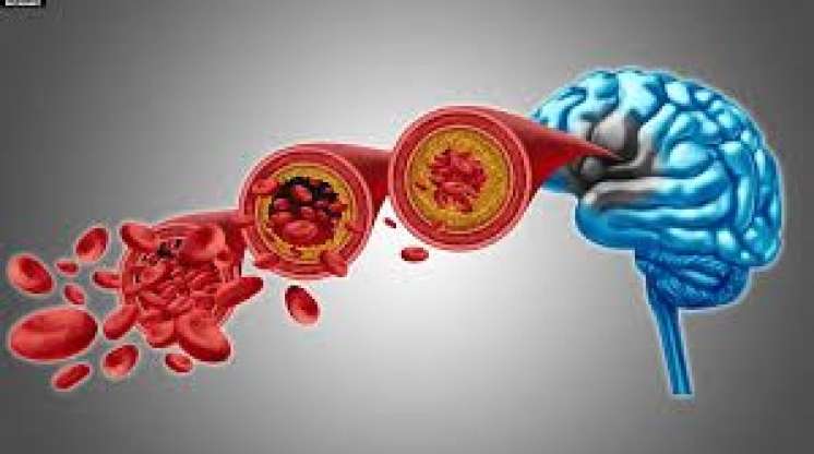 Beyninə qan az gedir?    - Bu əlamətlər varsa...