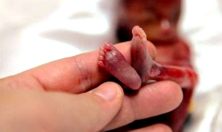  - Həkim fəsadlarını AÇIQLADI/VİDEO Abort qadının ölümü ilə nəticələnə bilər