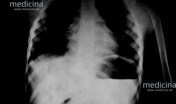Azərbaycanda 5 yaşlı qızın ürəyinə iynə batdı -   FOTOLAR