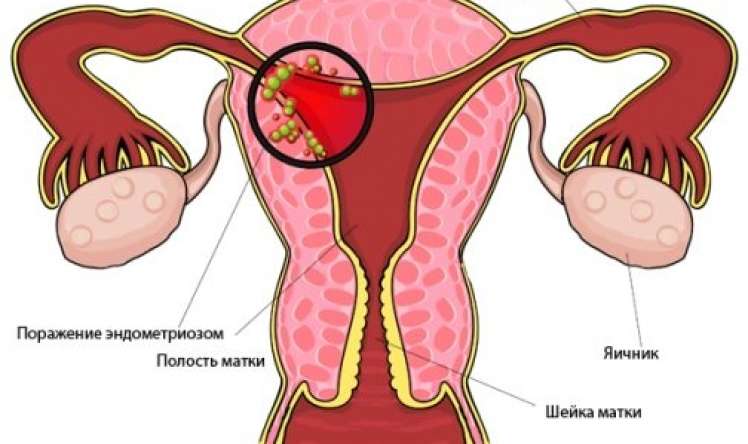 Endometrioz qadınların “baş bəlası” –  Sonsuzluğun səbəbidir