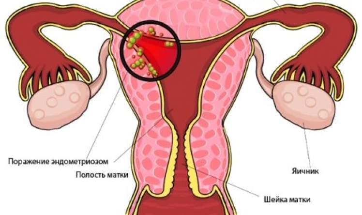 Endometrioz qadınların “baş bəlası” –  Sonsuzluğun səbəbidir