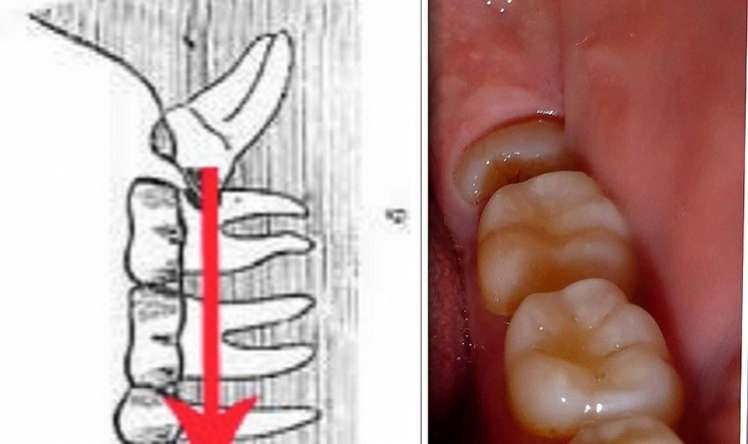 Ağıl dişləri haqqında 3 vacib sual-cavab  