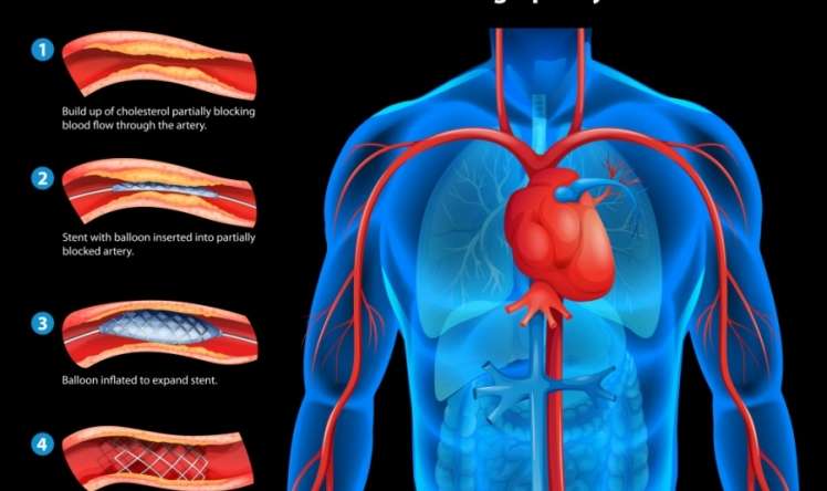 Təkrar stentin qoyulmasından xilas olacaqsız -  Ürək xəstələri üçün unikal müalicə