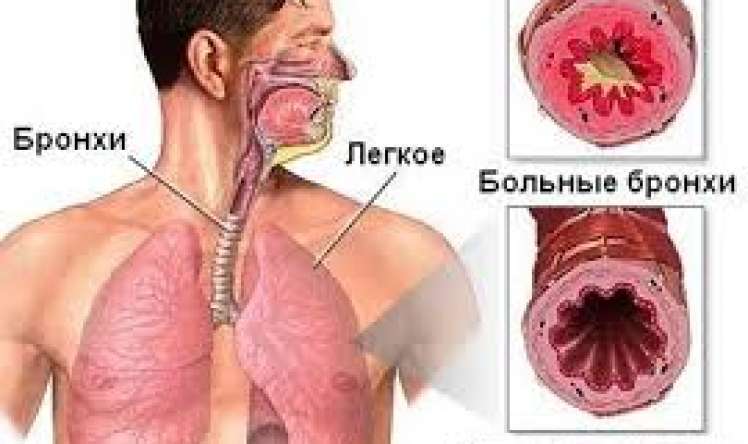 Bronxit astmaya çevrilə bilər, vaxtında müalicə olunun -  Məşhur həkim pulmonoloqdan xəbərdarlıq