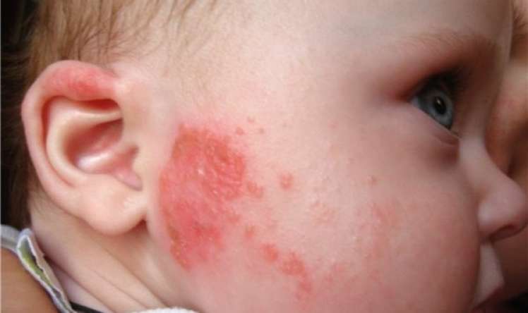 Uşaqlarda allergiyanın səbəbləri və düzgün müalicəsi –  Həkimdən VİDEO ÇIXIŞ