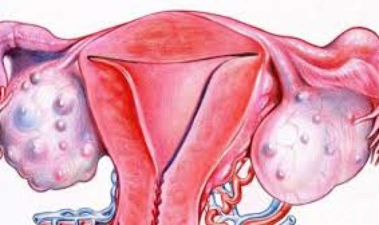 Subay qızlarda da rast gəlinən yumurtalıqların kistləri –  Müalicə, yoxsa əməliyyat?