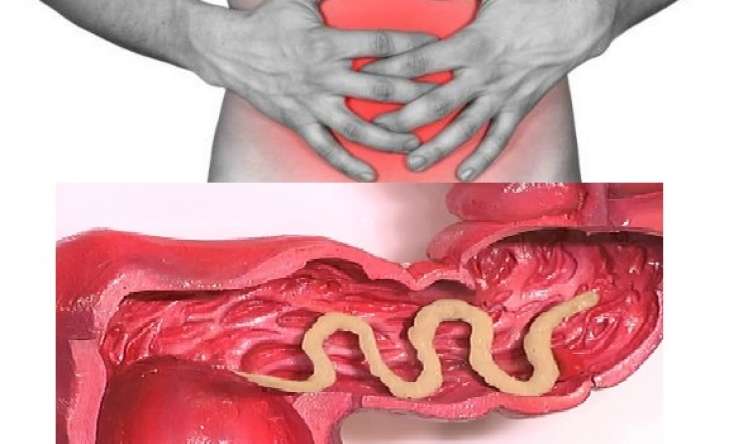 Parazitar qurdlardan bioloji metodlarla tam müalicə -  Həkim məsləhəti